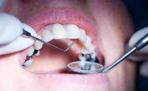 dental amalgam fillings